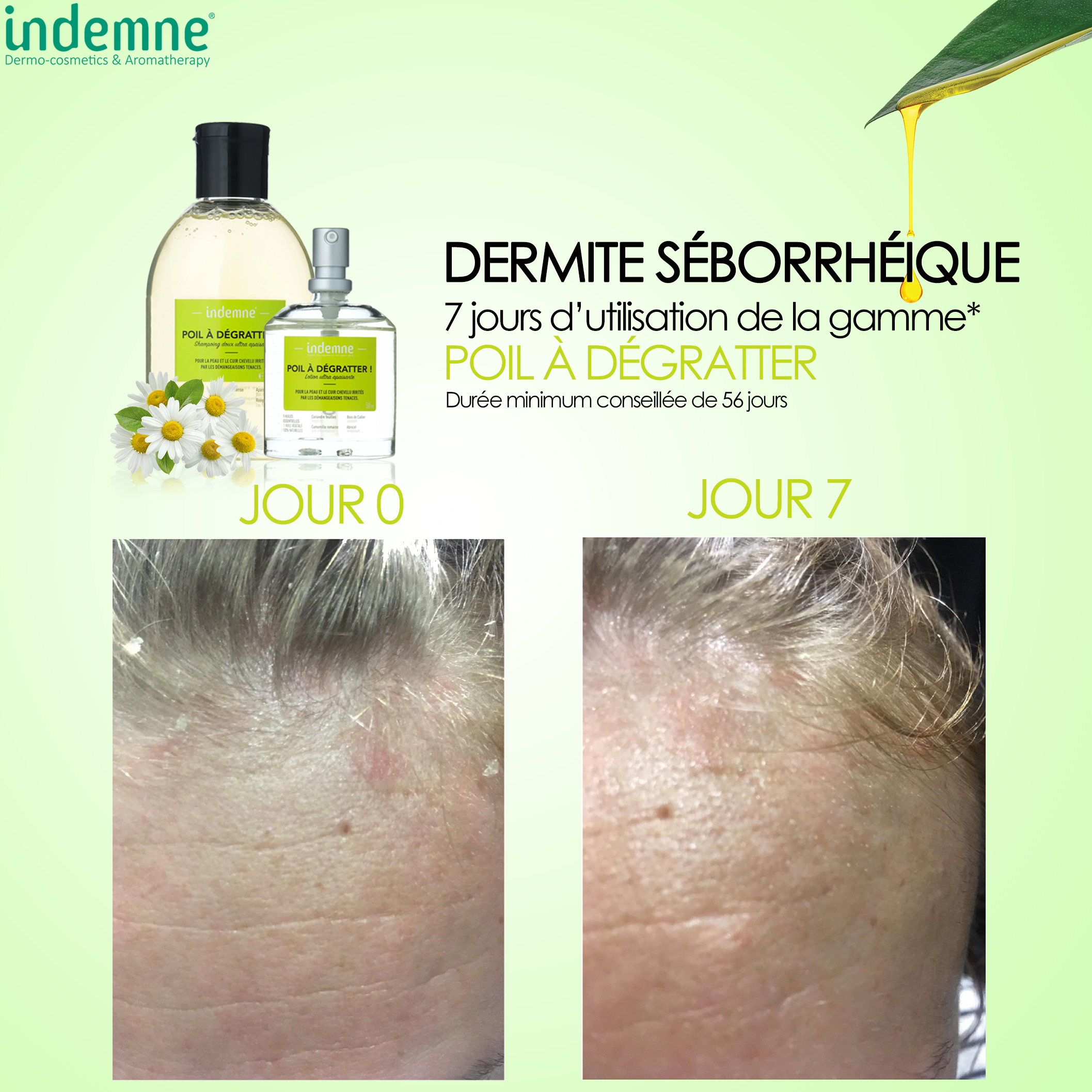 Cuir Chevelu Qui Pele Remede Grand Mere Croute Cuir Chevelu Remede Grand-Mere / Psoriasis cuir chevelu, remèdes